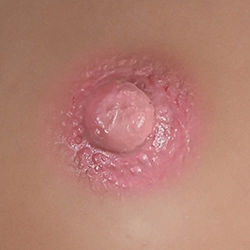 Areola-Rosa